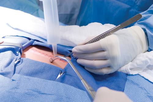 Surgical nurse performing perioperative care during a medical procedure.